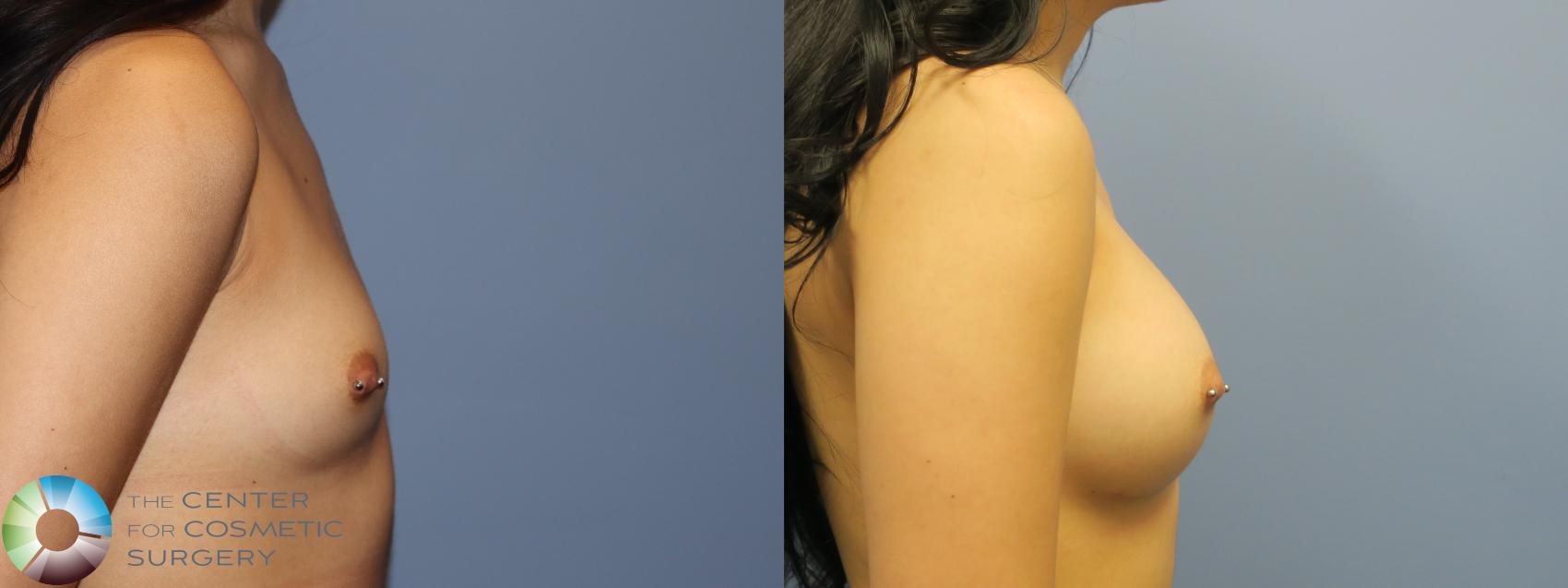 Before & After Breast Augmentation Case 11764 Right Side in Denver and Colorado Springs, CO