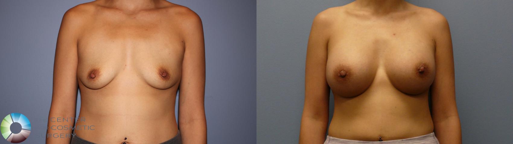 Before & After Breast Augmentation Case 11772 Front View in Golden, CO