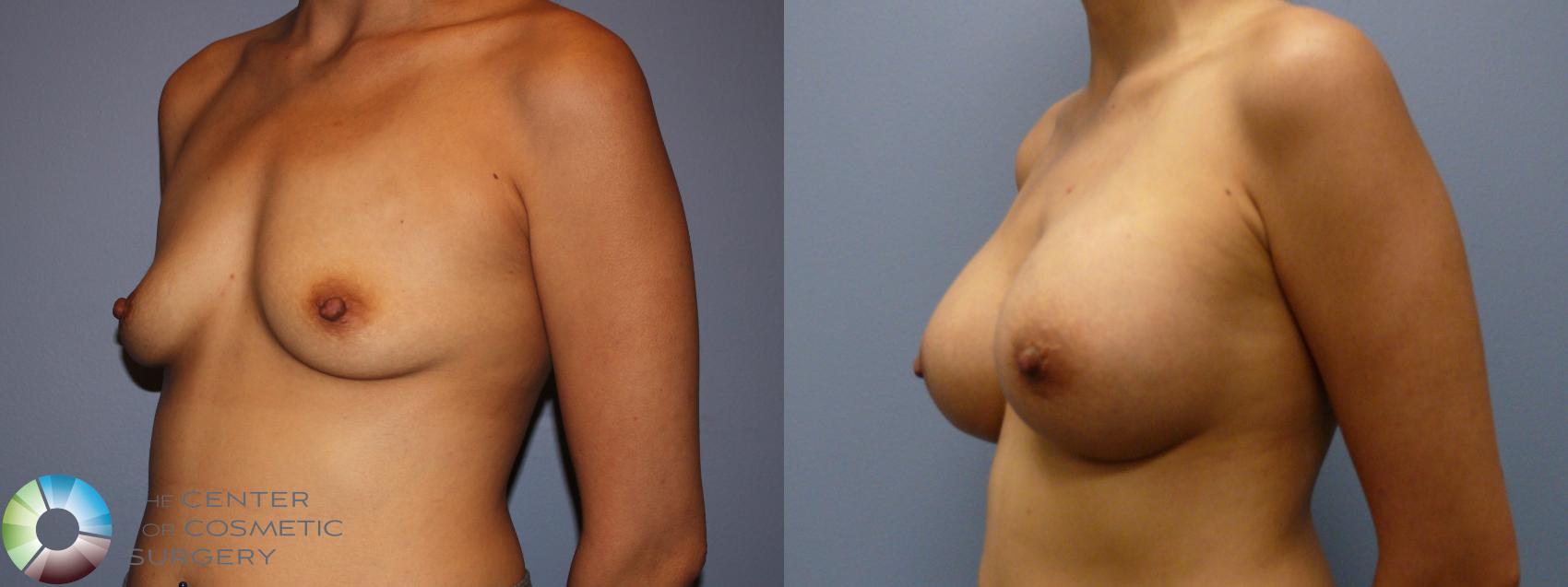 Before & After Breast Augmentation Case 11772 Left Oblique View in Golden, CO