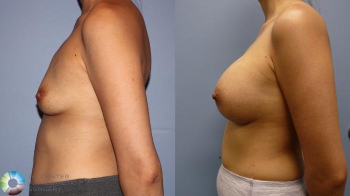 Before & After Breast Augmentation Case 11772 Left Side View in Golden, CO