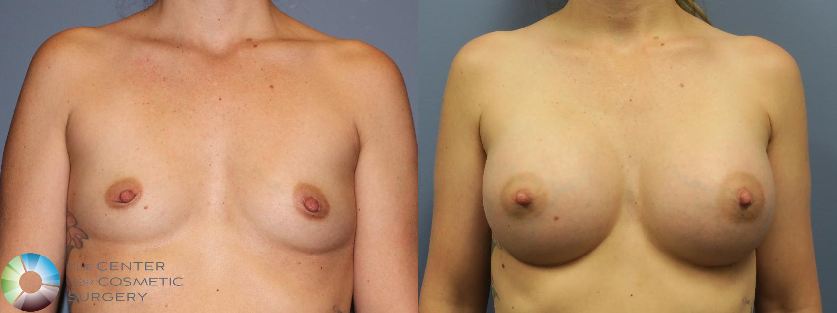 Before & After Breast Augmentation Case 11789 Front in Denver and Colorado Springs, CO