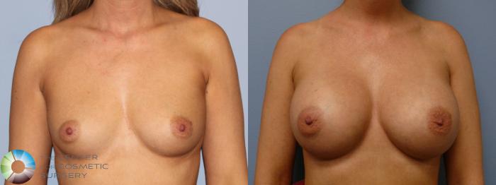 Before & After Breast Augmentation Case 11790 Front View in Golden, CO