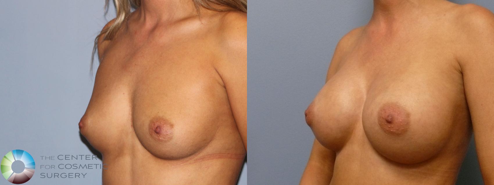 Before & After Breast Augmentation Case 11790 Left Oblique in Denver and Colorado Springs, CO