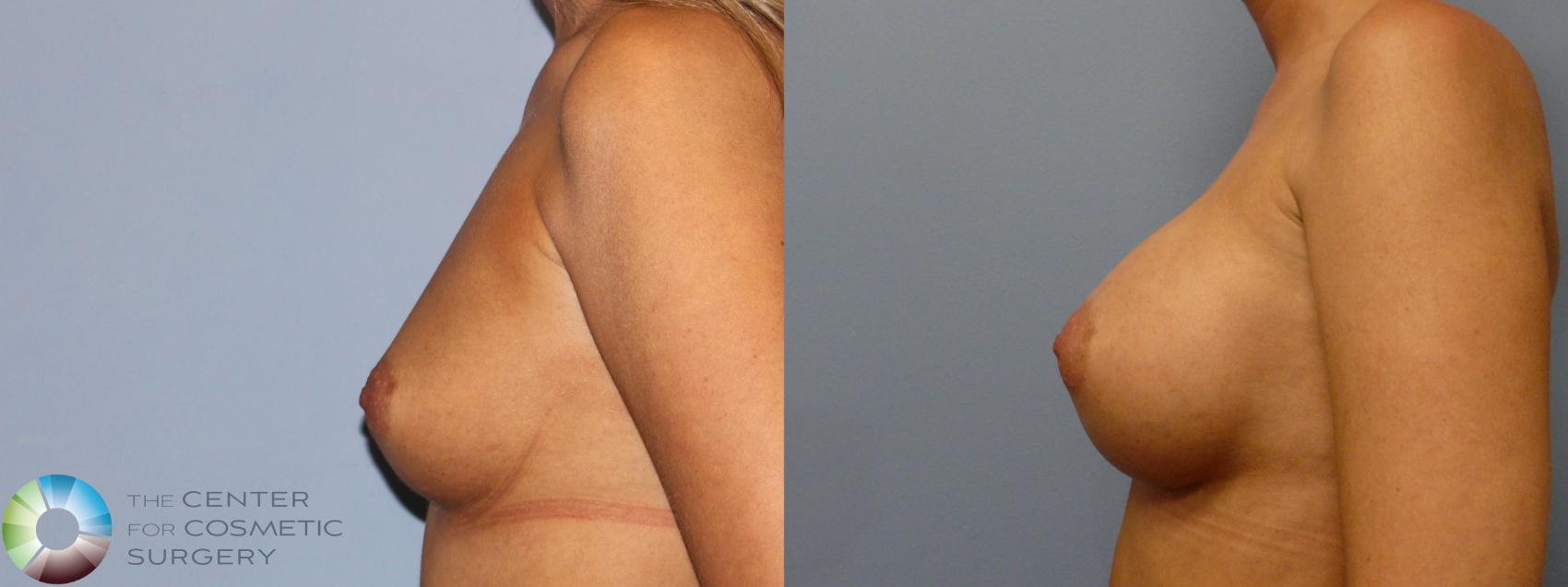 Before & After Breast Augmentation Case 11790 Left Side in Denver and Colorado Springs, CO