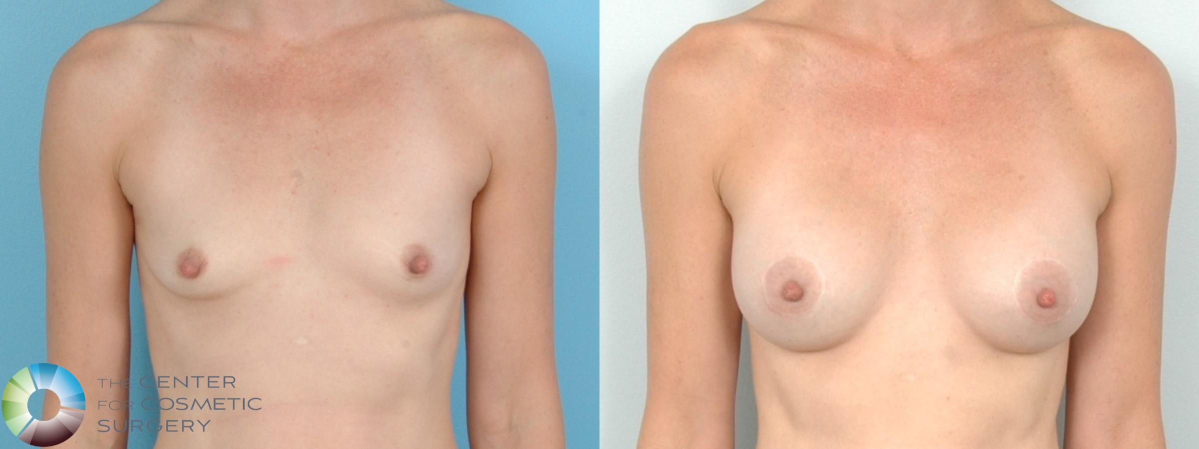 Before & After Breast Augmentation Case 11800 Front View in Denver & Golden, CO