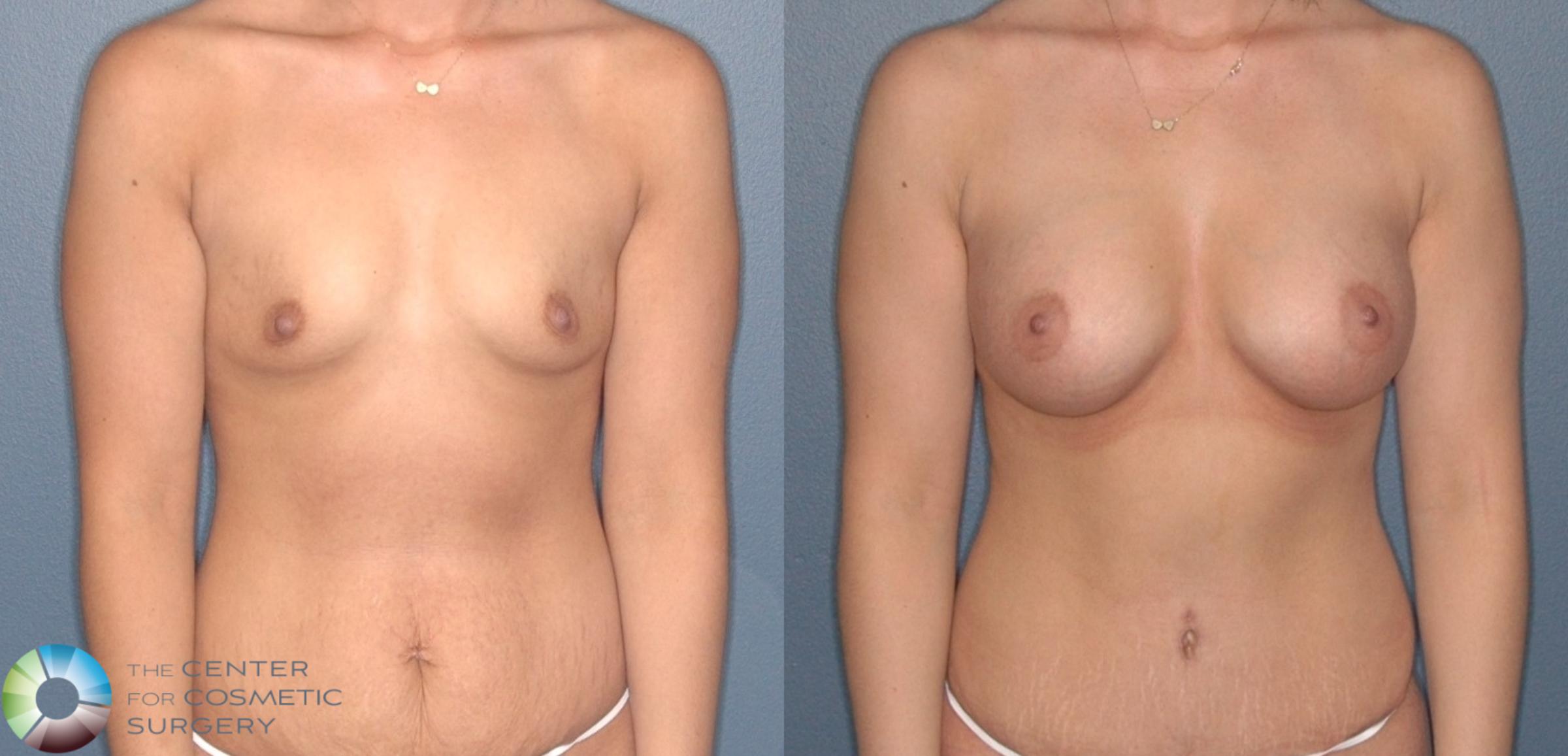 Before & After Breast Augmentation Case 11812 Front View in Denver & Golden, CO