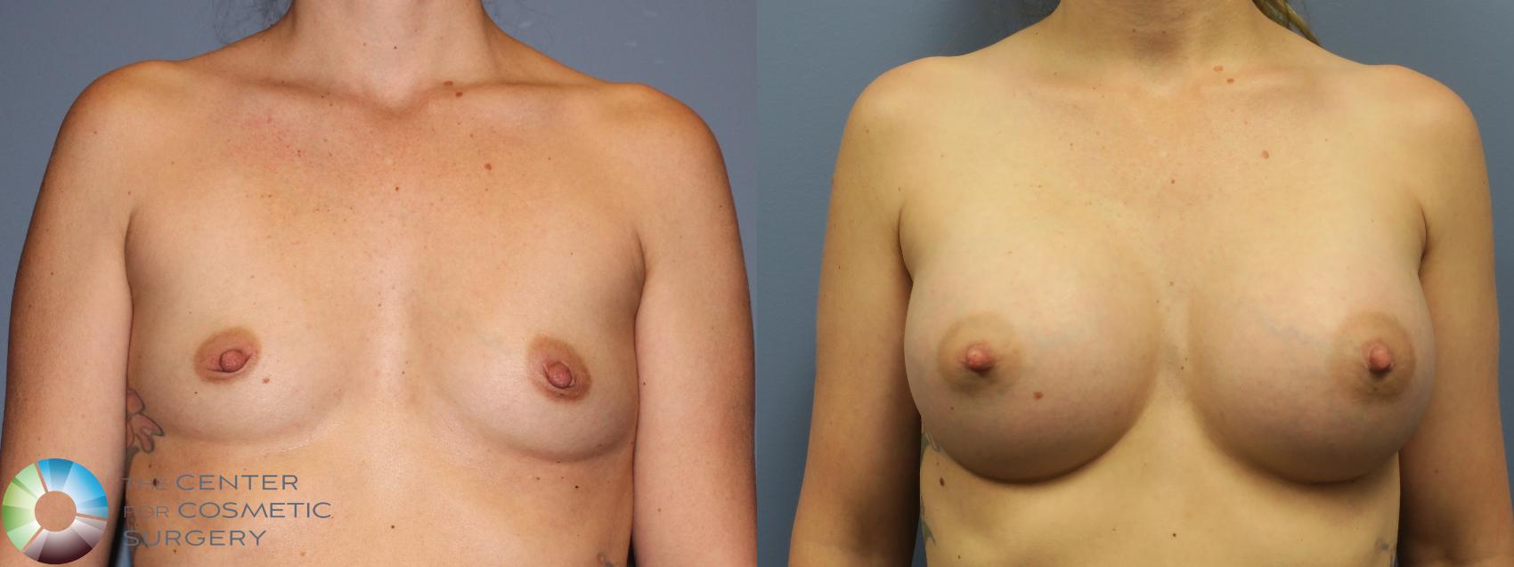 Before & After Breast Augmentation Case 11855 Front in Denver and Colorado Springs, CO