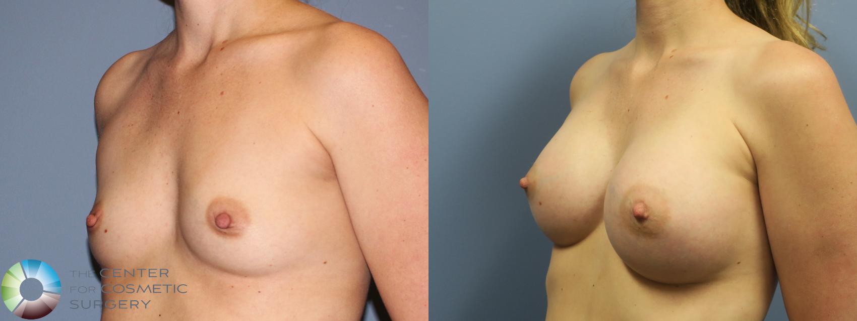 Before & After Breast Augmentation Case 11855 Left Oblique in Denver and Colorado Springs, CO