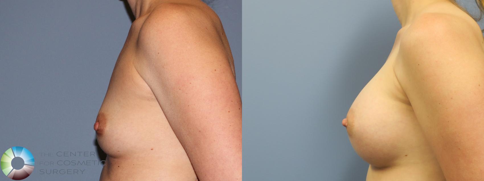 Before & After Breast Augmentation Case 11855 Left Side in Denver and Colorado Springs, CO