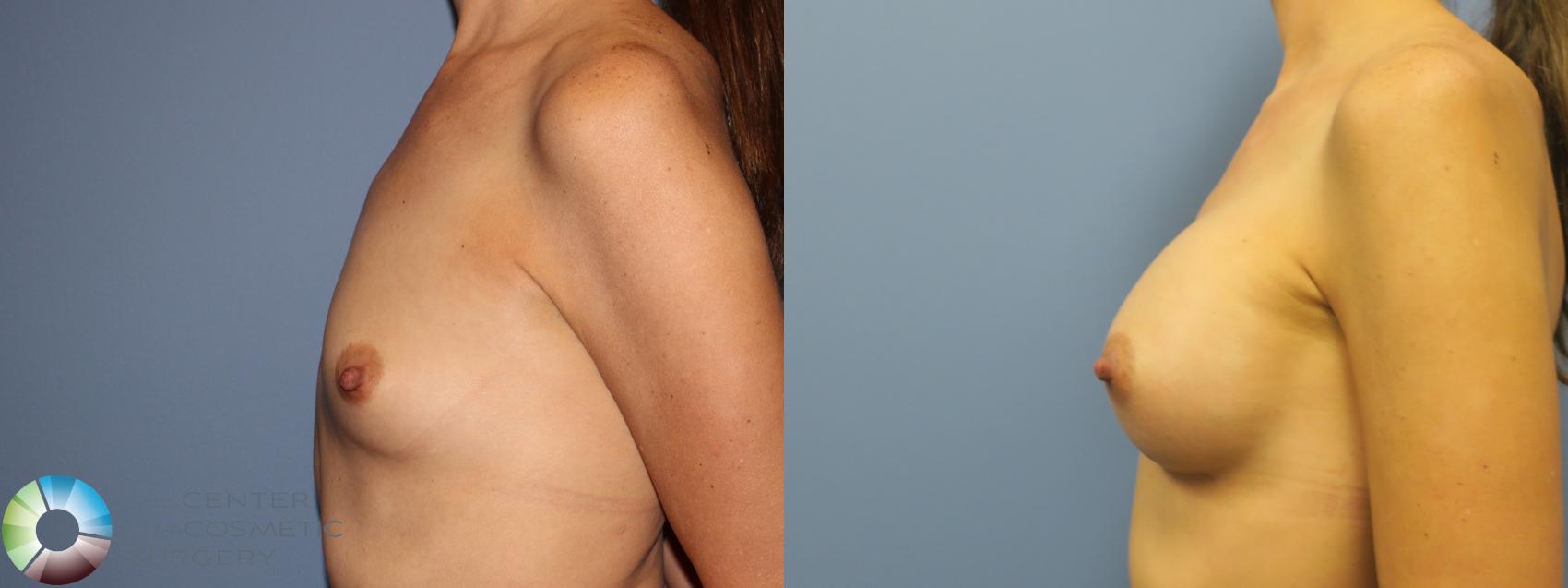 Before & After Breast Augmentation Case 11856 Left Side in Denver and Colorado Springs, CO