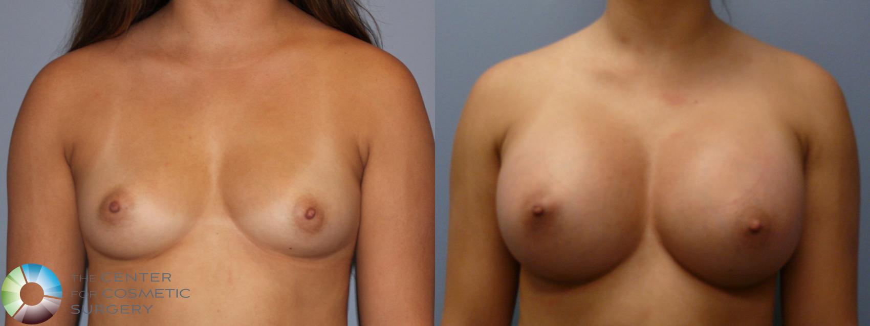 Before & After Breast Augmentation Case 11857 Front in Denver and Colorado Springs, CO