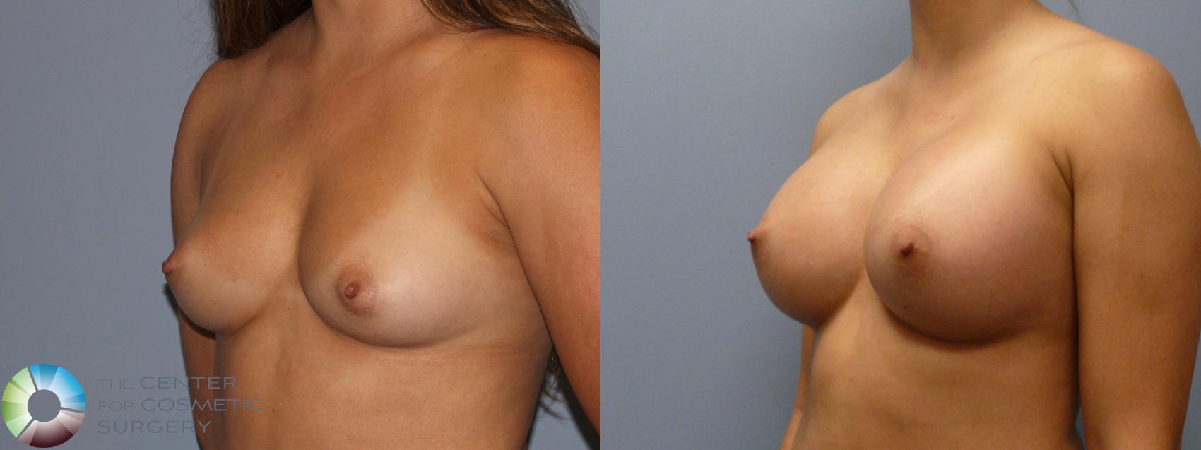 Before & After Breast Augmentation Case 11857 Left Oblique in Denver and Colorado Springs, CO