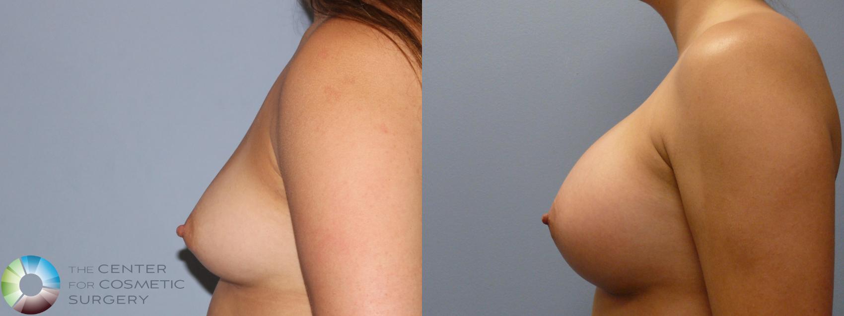 Before & After Breast Augmentation Case 11857 Left Side in Denver and Colorado Springs, CO