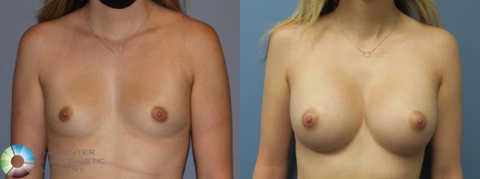 Before & After Breast Augmentation Case 11858 Front View in Golden, CO