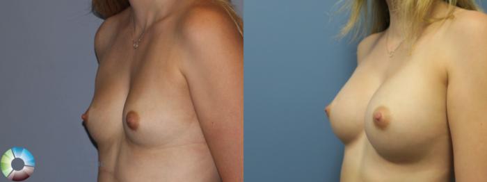 Before & After Breast Augmentation Case 11858 Left Oblique View in Golden, CO