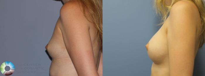 Before & After Breast Augmentation Case 11858 Left Side View in Golden, CO