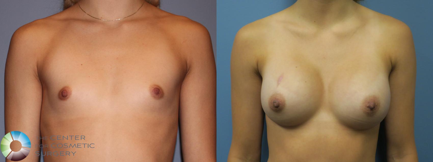 Before & After Breast Augmentation Case 11859 Front in Denver and Colorado Springs, CO