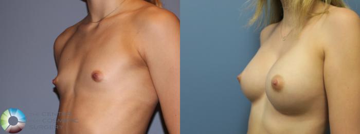 Before & After Breast Augmentation Case 11859 Left Oblique in Denver and Colorado Springs, CO
