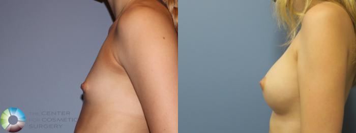 Before & After Breast Augmentation Case 11859 Left Side in Denver and Colorado Springs, CO