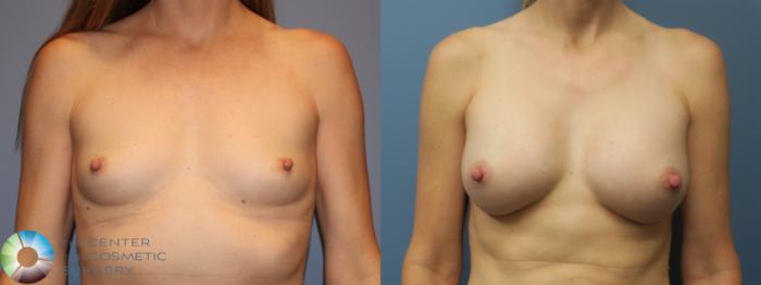 Before & After Breast Augmentation Case 11860 Front View in Golden, CO