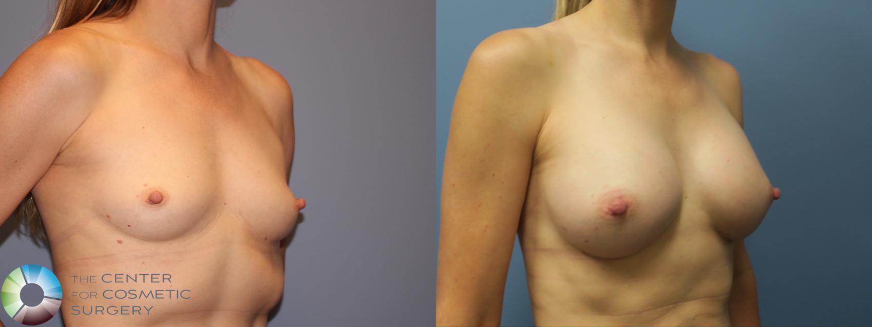 Before & After Breast Augmentation Case 11860 Right Oblique View in Golden, CO