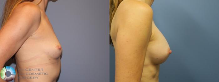 Before & After Breast Augmentation Case 11860 Right Side View in Golden, CO