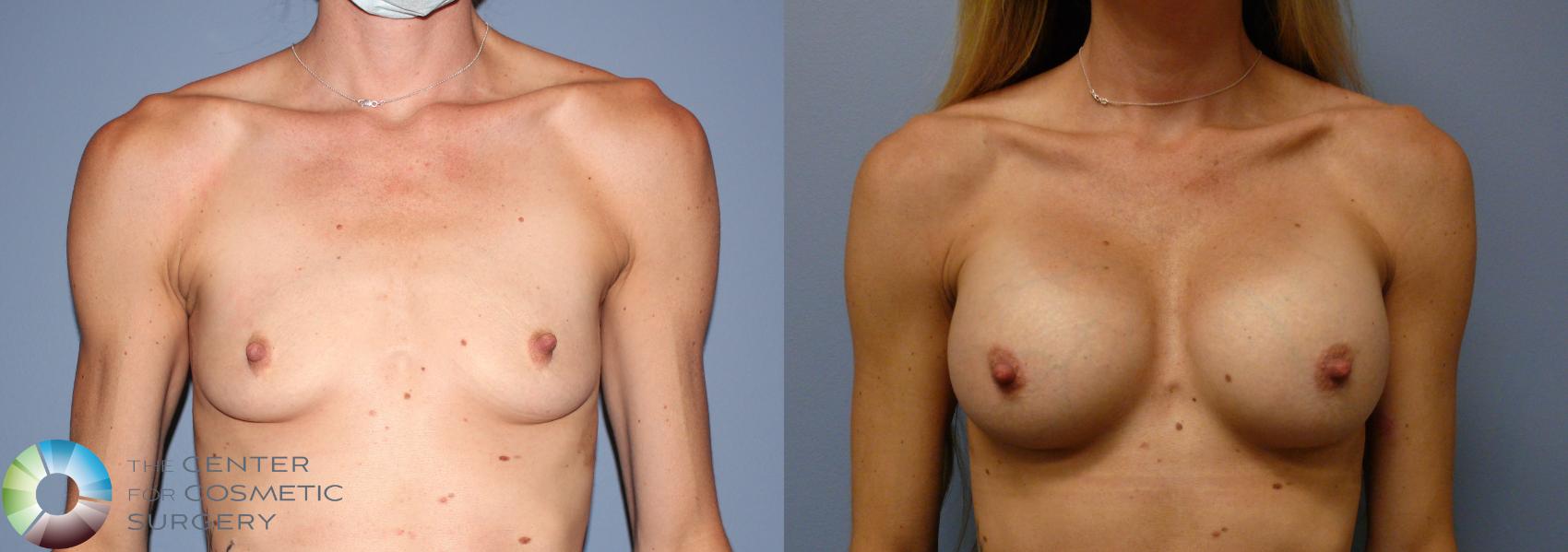 Before & After Breast Augmentation Case 11863 Front in Denver and Colorado Springs, CO