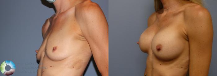 Before & After Breast Augmentation Case 11863 Left Oblique in Denver and Colorado Springs, CO