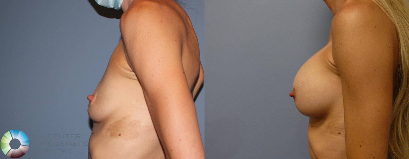 Before & After Breast Augmentation Case 11863 Left Side in Denver and Colorado Springs, CO