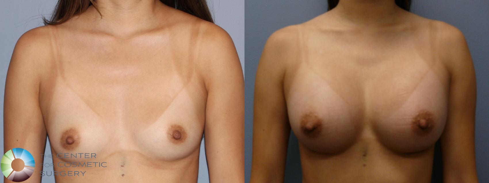 Before & After Breast Augmentation Case 11864 Front in Denver, CO