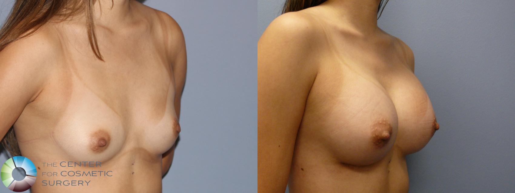 Before & After Breast Augmentation Case 11864 Left Oblique in Denver and Colorado Springs, CO