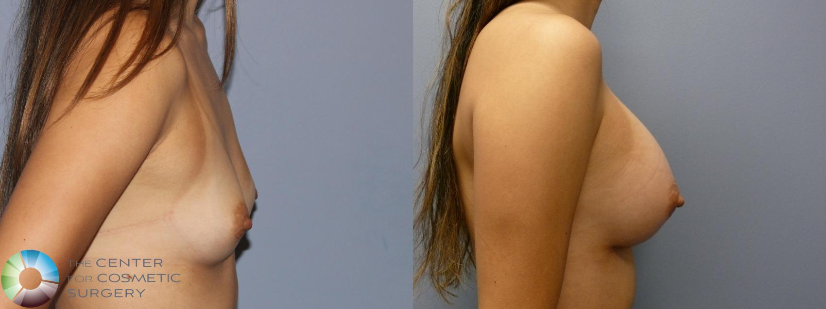 Before & After Breast Augmentation Case 11864 Left Side in Denver and Colorado Springs, CO