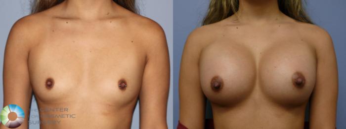 Before & After Breast Augmentation Case 11887 Front in Denver and Colorado Springs, CO