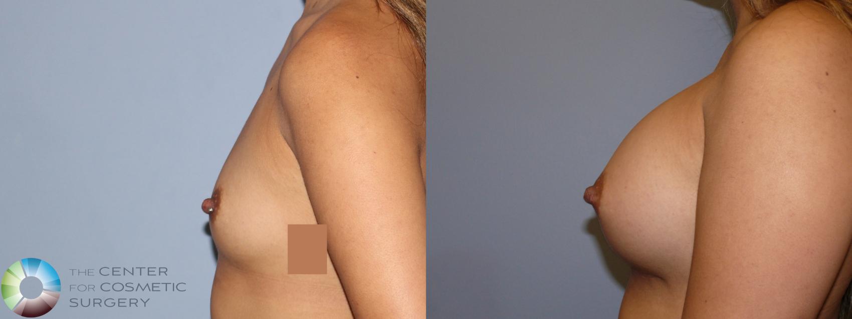 Before & After Breast Augmentation Case 11887 Left Side in Denver and Colorado Springs, CO