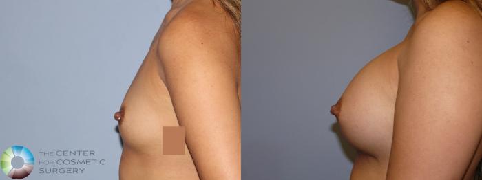 Before & After Breast Augmentation Case 11887 Left Side in Denver and Colorado Springs, CO