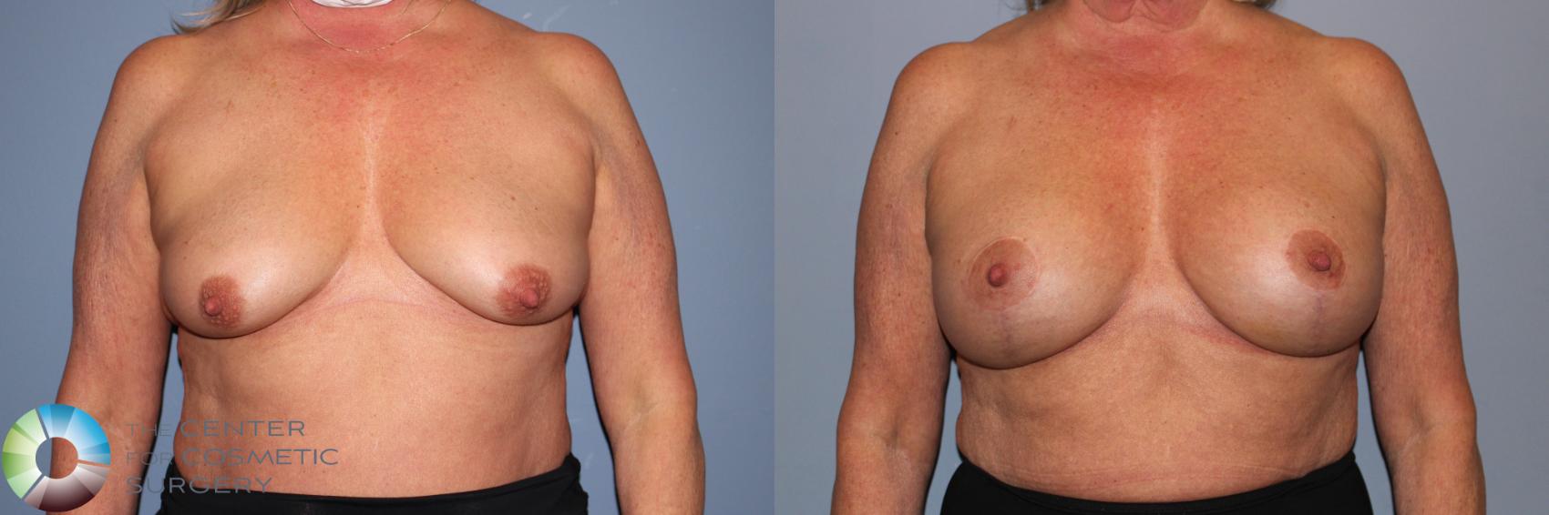 Before & After Breast Augmentation Case 11893 Front View in Golden, CO