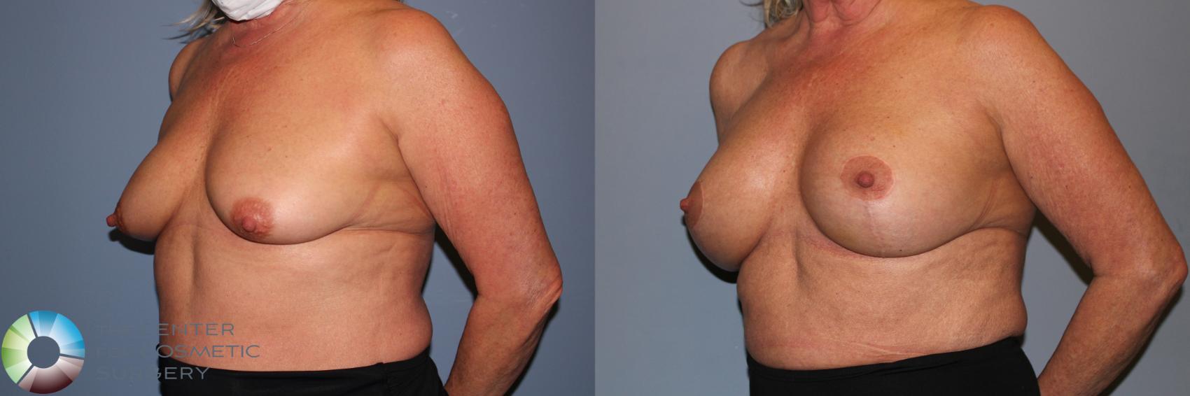 Before & After Breast Augmentation Case 11893 Left Oblique in Denver and Colorado Springs, CO