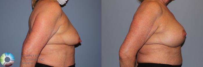 Before & After Breast Augmentation Case 11893 Right Side View in Golden, CO