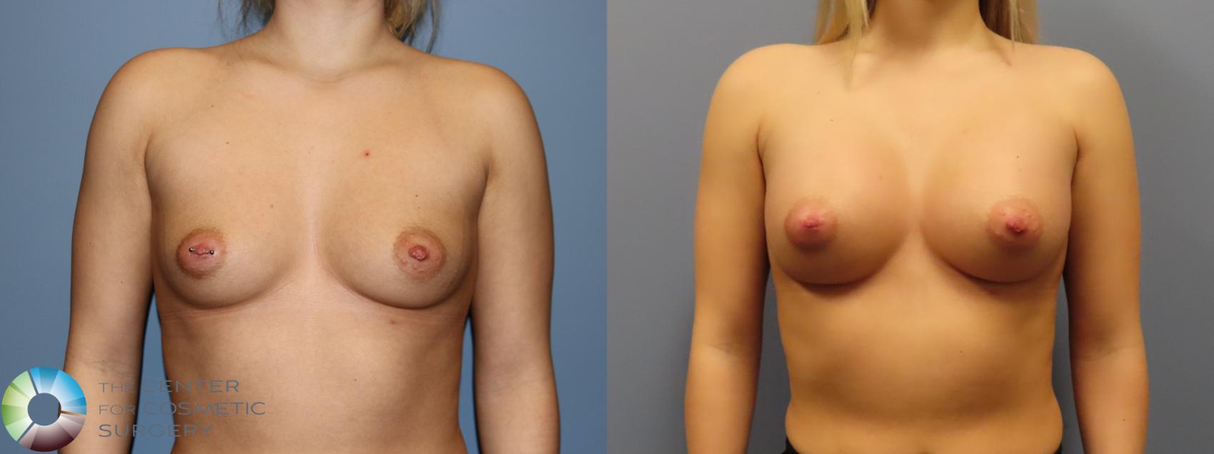 Before & After Breast Augmentation Case 11901 Front View in Golden, CO