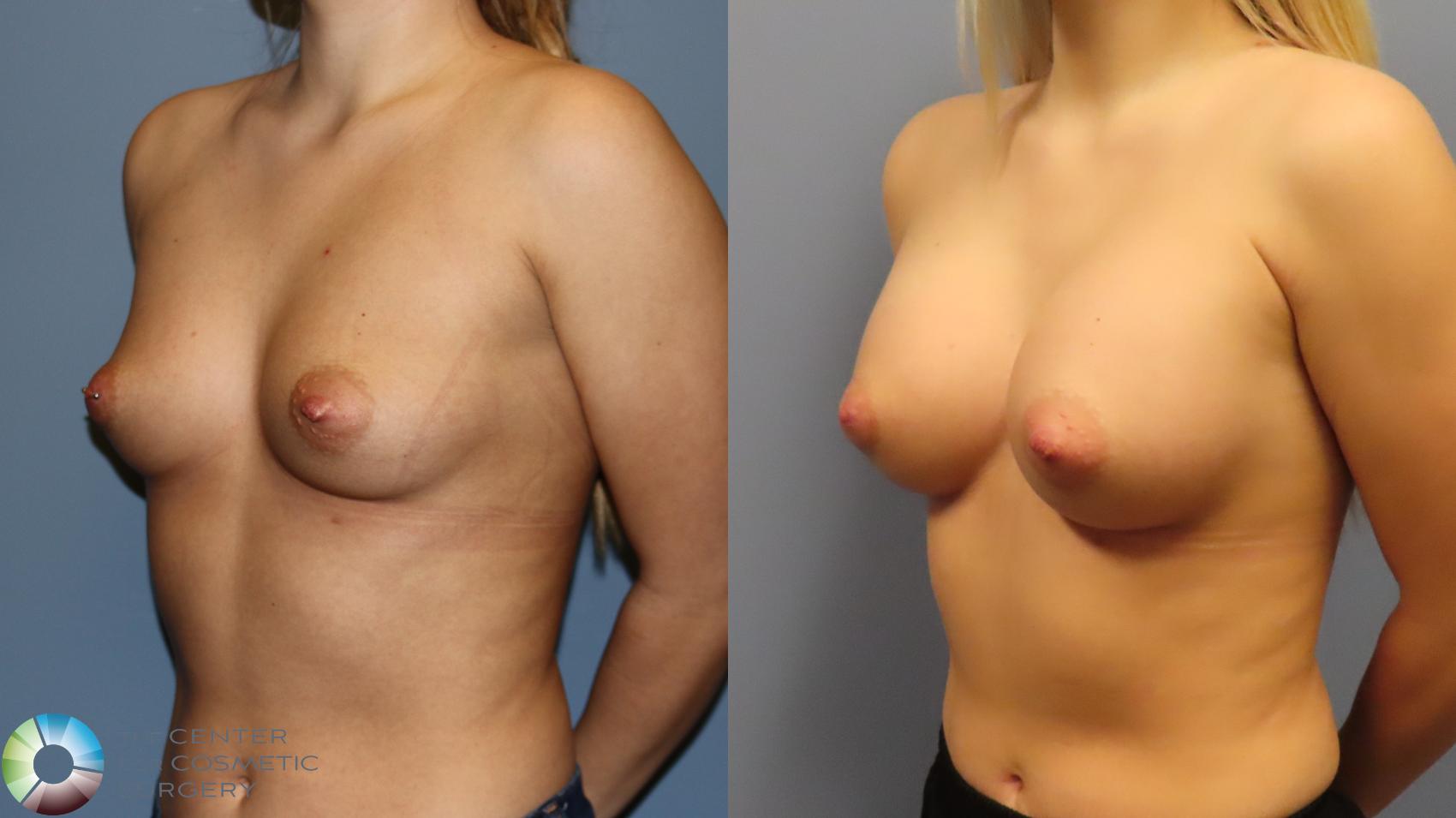 Before & After Breast Augmentation Case 11901 Left Oblique in Denver and Colorado Springs, CO