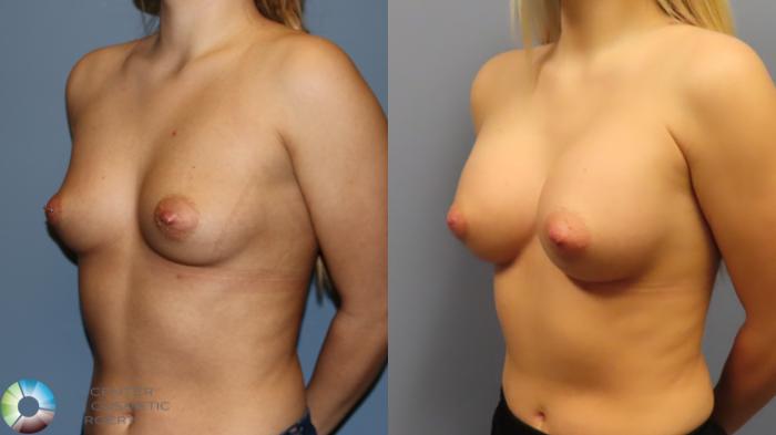 Before & After Breast Augmentation Case 11901 Left Oblique View in Golden, CO