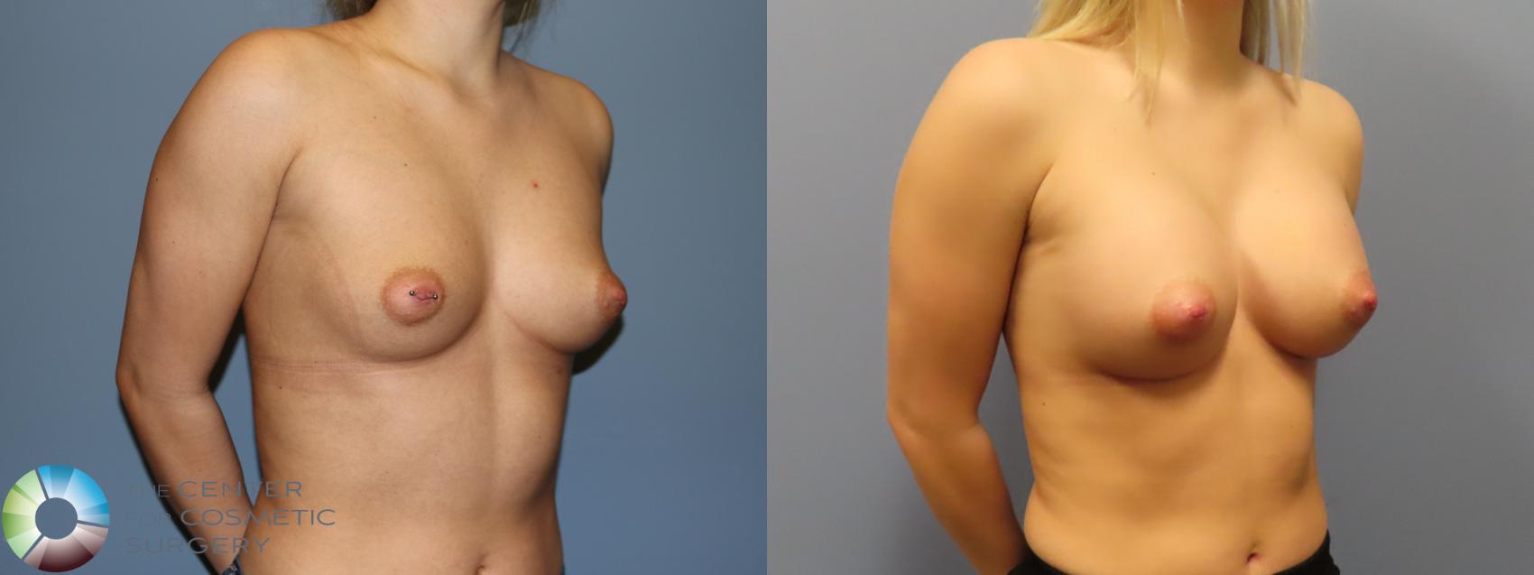 Before & After Breast Augmentation Case 11901 Right Oblique in Denver and Colorado Springs, CO