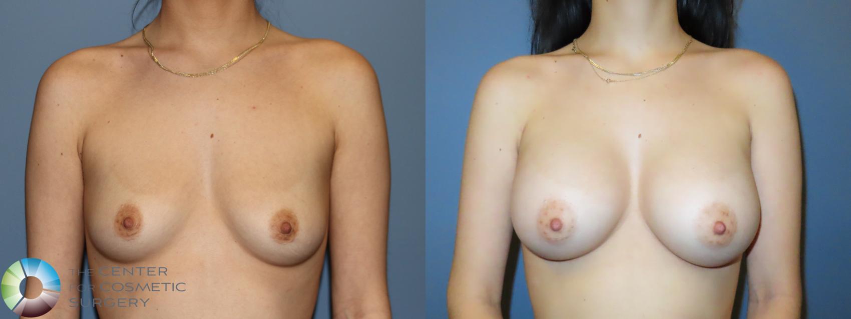 Before & After Breast Augmentation Case 11908 Front in Denver and Colorado Springs, CO