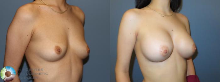 Before & After Breast Augmentation Case 11908 Right Oblique View in Golden, CO