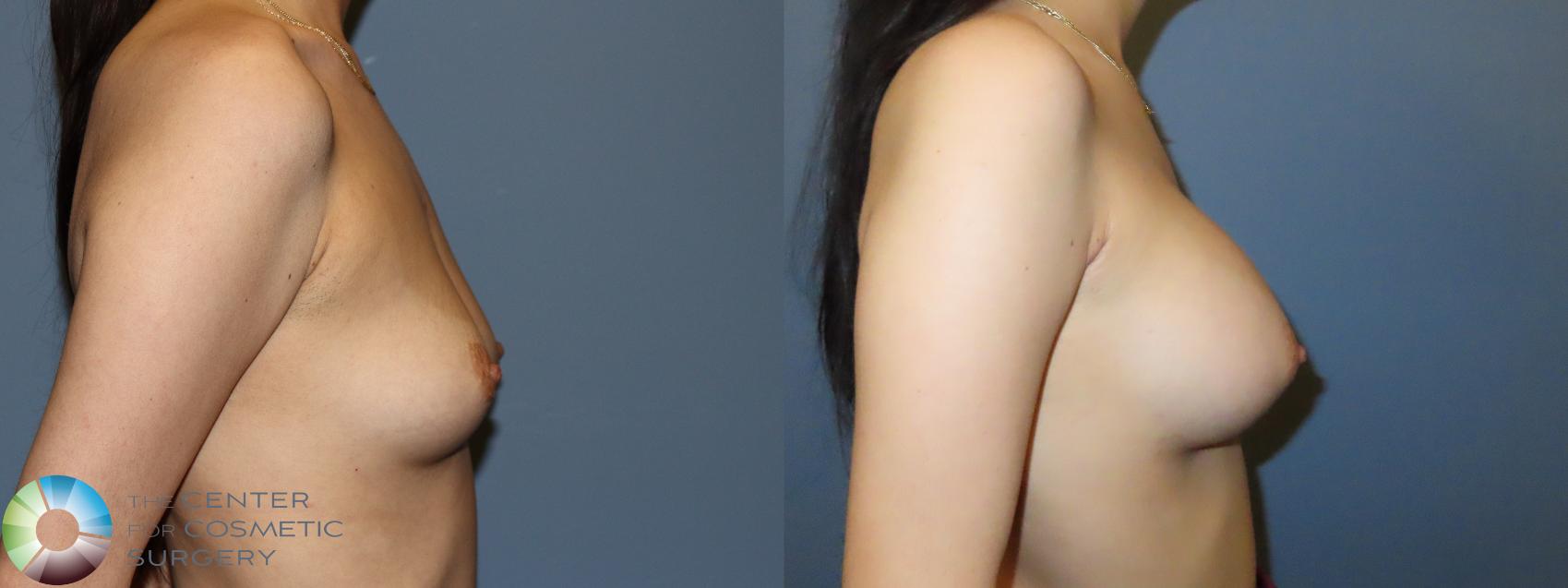 Before & After Breast Augmentation Case 11908 Right Side in Denver and Colorado Springs, CO