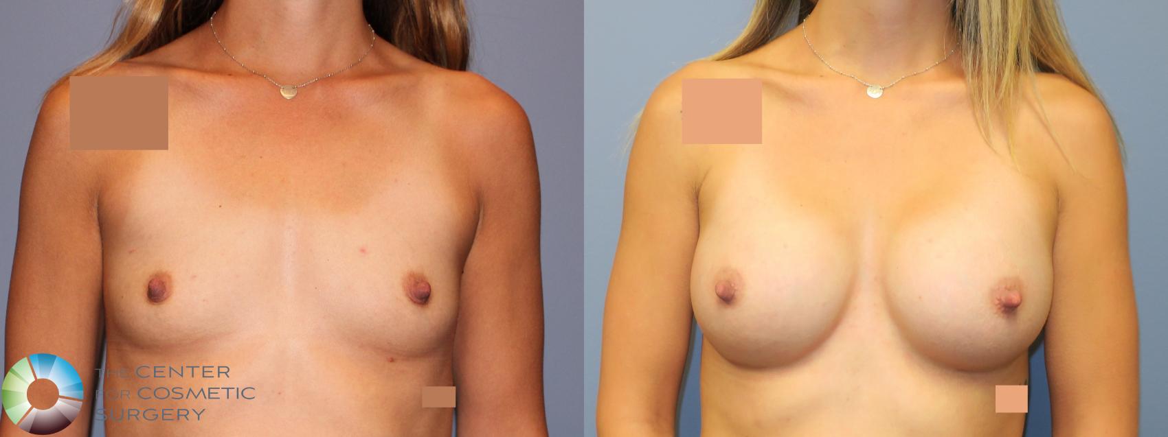 Before & After Breast Augmentation Case 11909 Front in Denver and Colorado Springs, CO