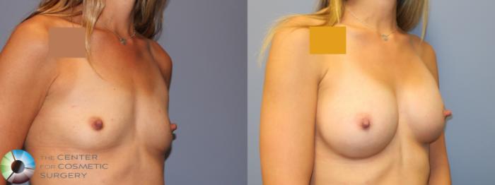Before & After Breast Augmentation Case 11909 Right Oblique in Denver and Colorado Springs, CO