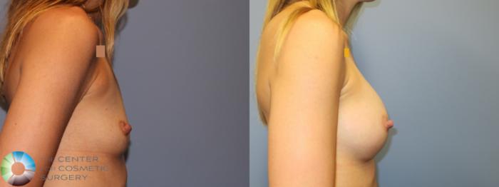 Before & After Breast Augmentation Case 11909 Right Side in Denver and Colorado Springs, CO