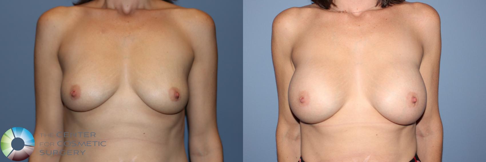 Before & After Breast Augmentation Case 11911 Front in Denver and Colorado Springs, CO