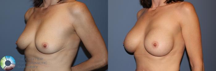 Before & After Breast Augmentation Case 11911 Left Oblique in Denver and Colorado Springs, CO